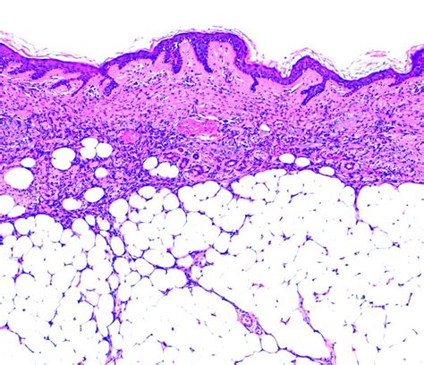 Pathology Outlines Dermatofibrosarcoma Protuberans Dfsp