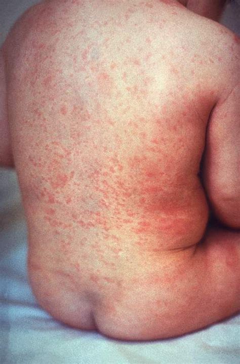 Approach To A Patient With Rash Measles Symptoms Nummular Eczema