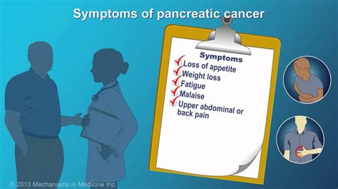 Pancreatic Cancer Signs Symptoms And Risk Factors Youtube