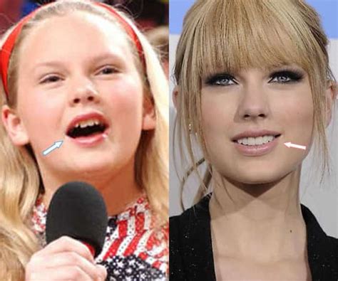 Taylor Swift Teeth Before Veneers