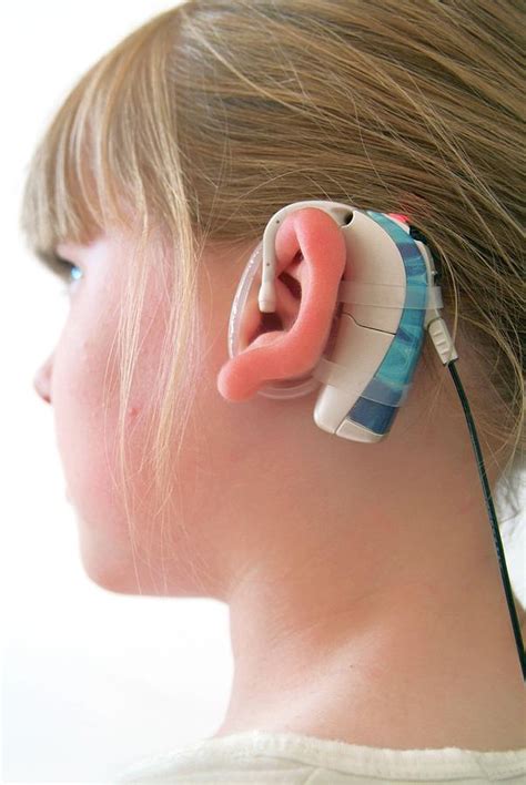 Cochlear Implant Photograph By Hannah Gal Science Photo Library