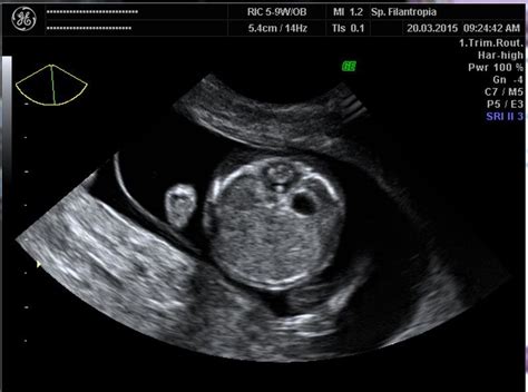 Ultrasound Image Showing A Transverse Section Of The Upper Abdomen Of