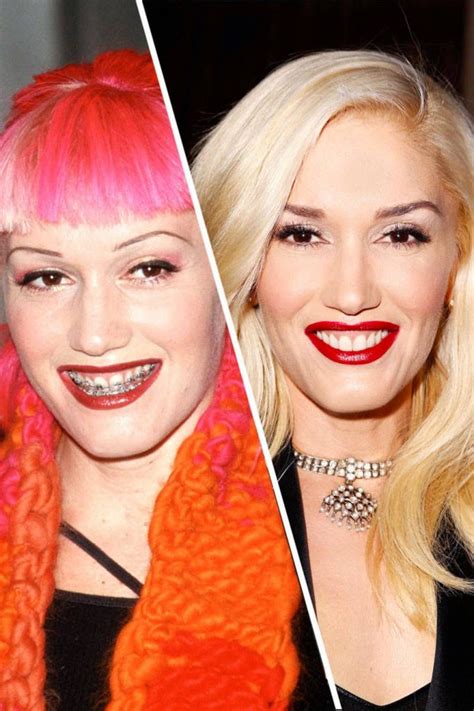 Look How Gwen Stefanis Plastic Surgery Has Helped Her Shift From