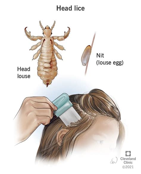 Head Lice Signs Symptoms Causes Treatment 2023