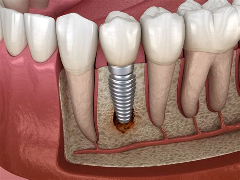 Dental Implant Complications Shreveport Periodontics