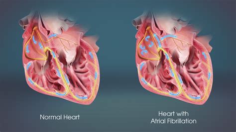 Atrial Fibrillation And Related Cardiac Risks Scientific Animations