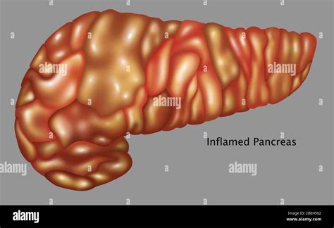 Inflamed Pancreas Illustration Stock Photo Alamy