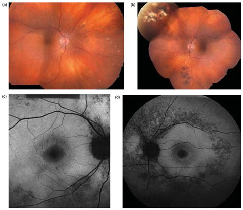 Case 2 Fundus Photographs A And B Reveal Peripapillary Atrophy In Both