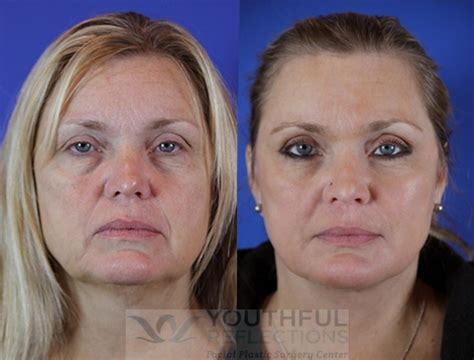 Co2 Laser Skin Resurfacing Before And After Photos Patient 29 Nashville
