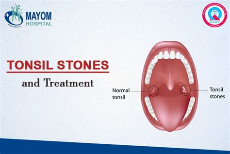 Tonsil Stones And Treatment Ent Specialist In Gurgaon By Rohan