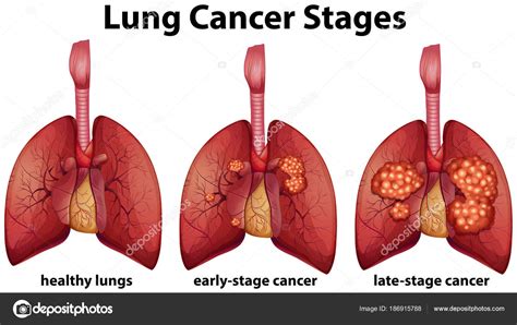 Lung Cancer Maismaismedicina