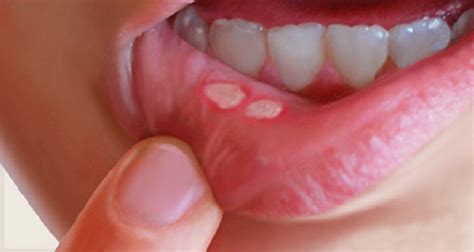 Canker Sores In The Mouth Here Is How To Naturally Get
