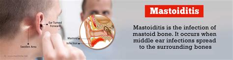 Mastoiditis Causes Symptoms Diagnosis Complications And Treatment