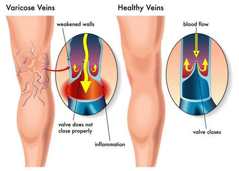 How To Get Rid Of Varicose Veins With These Simple Natural Remedies