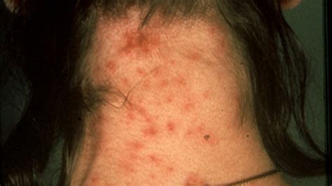 Skin Infection Pictures Causes And Treatments