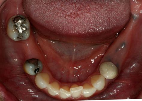 Pictures Of Partial Dentures For Back Teeth Teethwalls
