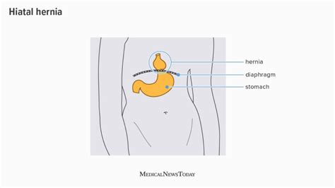 Hernia Pictures A Visual Guide To Different Hernia Types