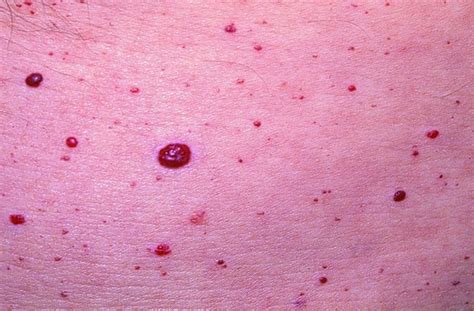 Cherry Angioma Pictures Causes Treatment Removal And Prevention