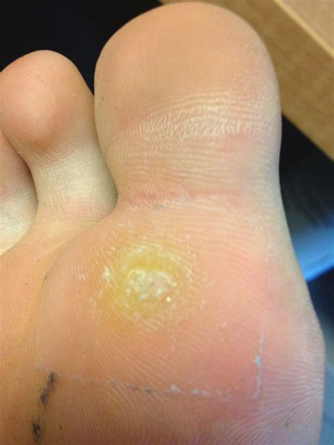 What is a planters wart look like. How To Get Rid Of Plantar Warts