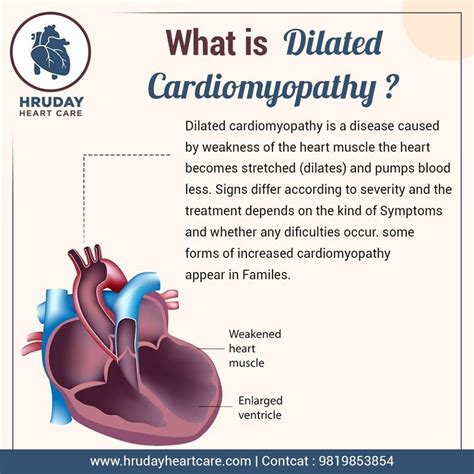 What Is Dilated Cardiomyopathy By Hruday Heart Care Medium