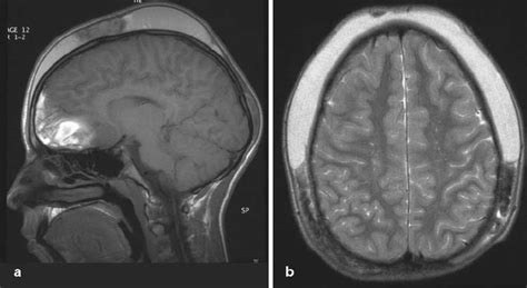 Hemorrhagic Cerebral Contusions And Subgaleal Hematoma In A 13 Year Old