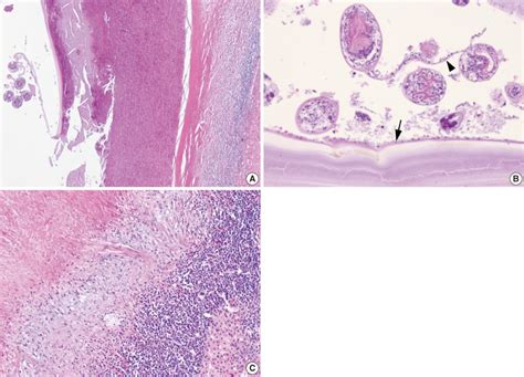 Histologic Findings A A Hydatid Cyst And Adjacent Liver Parenchyma