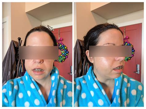 My Story Double Jaw Surgery And Septoplasty Photos