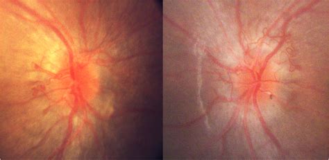 Fundus Photographs Of The Right And Left Optic Discs Demonstrating