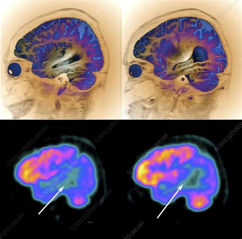 Alzheimers Disease Mri And Pet Brain Scans Stock Image C0388788