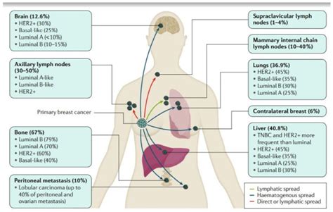 Can Breast Cancer Spread To Supraclavicular Lymph Nodes Updated