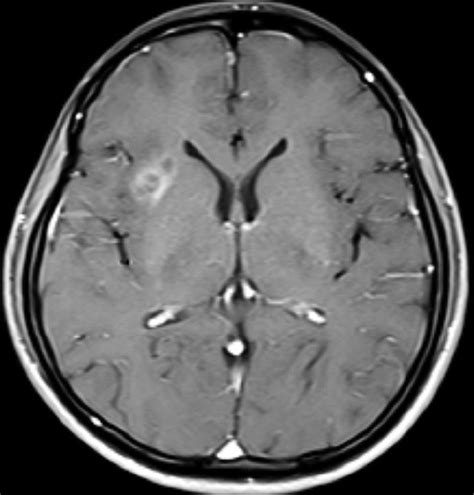 A Contrast Enhanced Mri Study Of The Brain Shows A Mass In A The Right