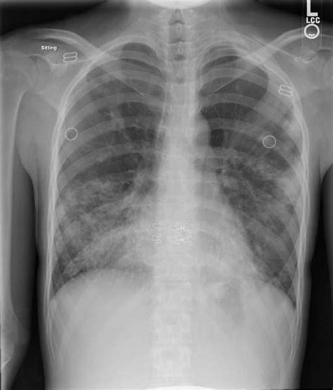 Tuberculosis Chest X Ray Wikidoc