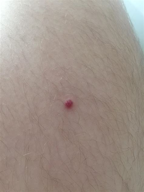 What Is This Assumed It Was Just A Weird Pimple But Its Been On My