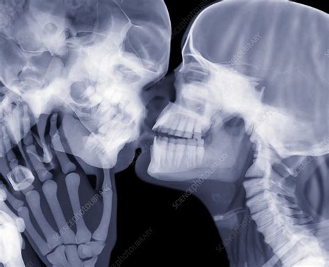 Lovers Kissing X Ray Stock Image C011 5767 Science Photo Library