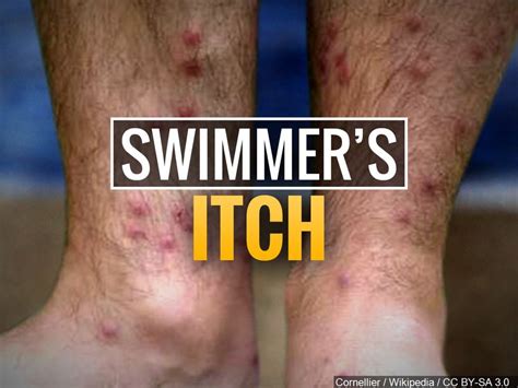 Watch Out For Swimmers Itch While Enjoying Anchorage Lakes