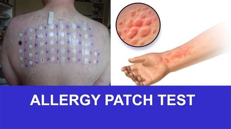 Allergy Patch Test Results Chart