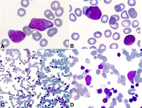 Photomicrography Of The Peripheral Blood Smear A B And Bone Marrow