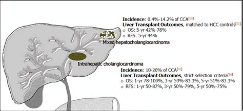 Liver Transplant Diagram