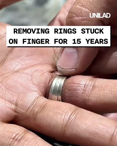 Removing Ring Stuck On Finger For 15 Years The Relief When They Came Off Must Have Been