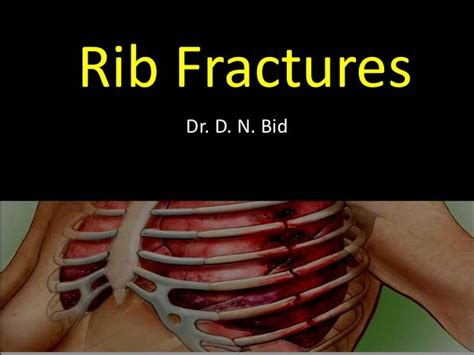 Rib Fractures Dnbid 2016