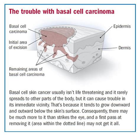 Nodular Basal Cell Carcinoma Nose
