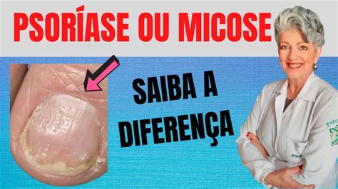 Saiba A Diferença Entre Psoríase Ungueal E Micose Youtube