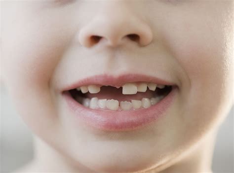 Kids And Missing Teeth—what Every Parent Should Know