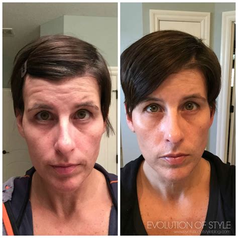 Rodan And Fields Before And After Wrinkles All You Need Infos