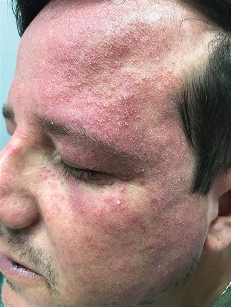 Pruritic And Pustular Eruption On The Face Mdedge Dermatology
