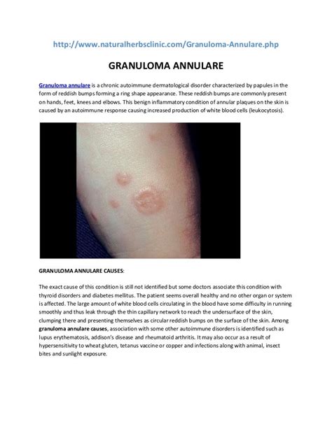 Granuloma Annulare Causes Symptoms Diagnosis Treatment