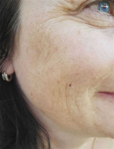 Unlocking The Mystery Of Melasma Everything You Need To Know About