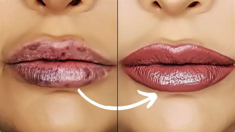 What Gets Rid Of Bruised Lips Lipstutorial Org