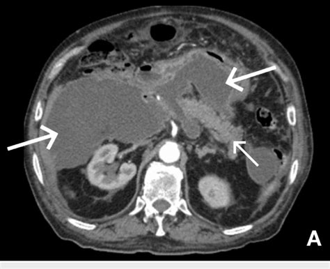 Ct Abdomenpelvis With Iv Contrast And Arrows Showing Multiple