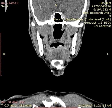 Parapharyngeal Space Mass Radiology Cervical Lymph Nodes Ct Annotated